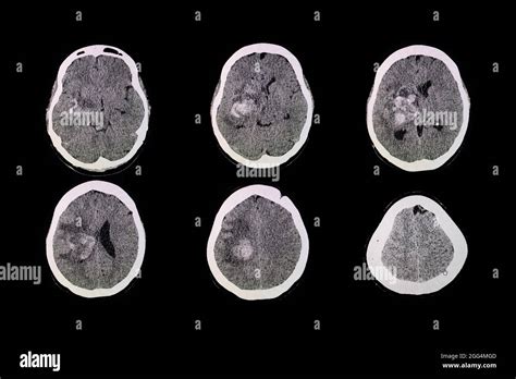 CT Brain Scan Of The Patient With Hemorrhage And Hematoma At Right