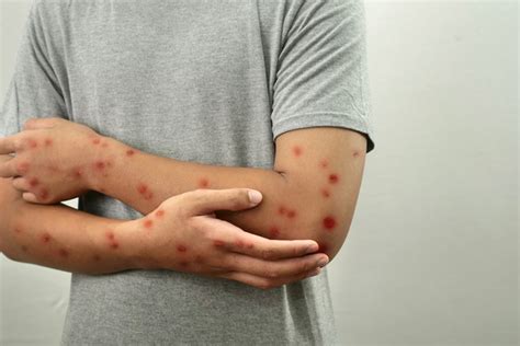 OMS Aprova Vacina Da Bavarian Nordic Contra Mpox Para Adolescentes