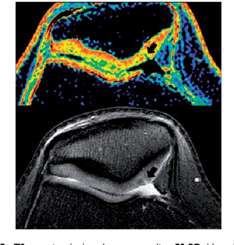 Figure 5 From A New MRI Grading System For Chondromalacia Patellae