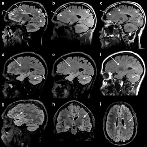 Sagittal Slices From A D D Flaired B E Ge D Flair And