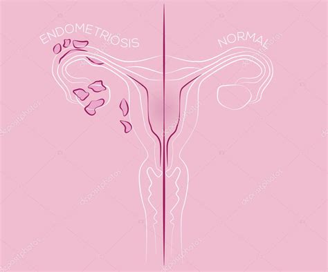 Ilustración de endometriosis tejido endometrial en el útero