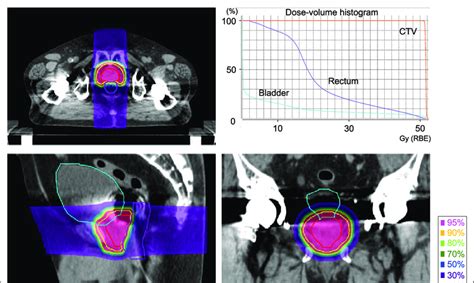 Dose Distribution And Dose Volume Histogram Dvh Total Dose