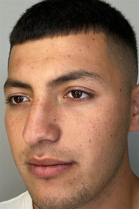 Los Angeles Rhinoplasty Before After Photos Patient 03 Dr Aminpour