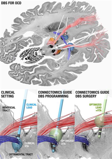 Frontiers Proceedings Of The Eighth Annual Deep Brain Stimulation