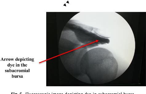 Figure 1 From Ultrasound Guided Versus Landmark Guided Corticosteroid Injection In Patients With