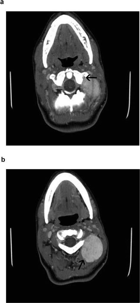 A Axial Image Of Ct At The Level Of C1 With Close Relation With Left Download Scientific