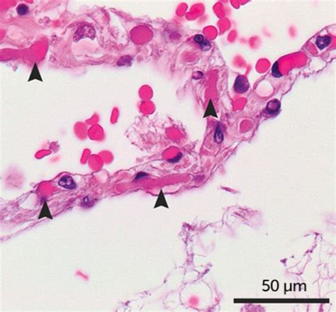 Cellix Solutions Mimic Microvascular Thrombosis Accelerating Covid 19