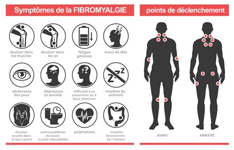 Comprendre La Fibromyalgie Causes Sympt Mes Et Traitement The Best