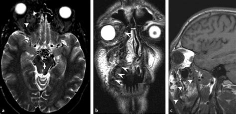 Syndromic Arteriovenous Malformations Neupsy Key