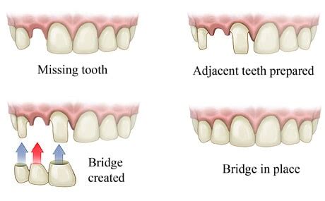 Dental Bridges, a Complete Overview