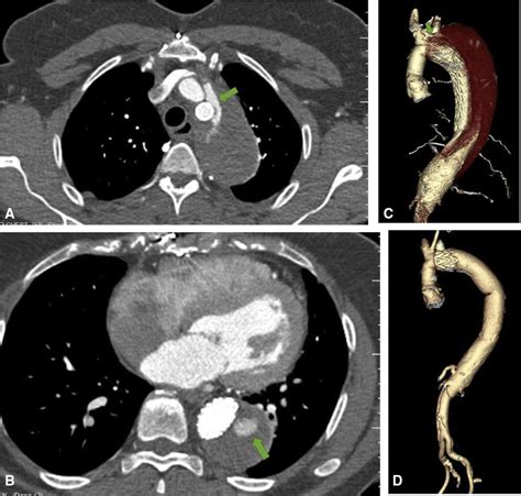 Case Preoperative Ct March Showing Persistent Proximal A