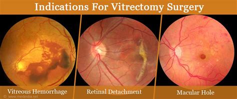 Vitrectomy Surgery Types Indications Procedure Complications