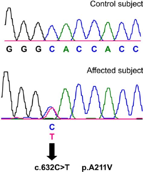 C 632C T Mutation In SLC17A8 Sequencing Chromatogram From