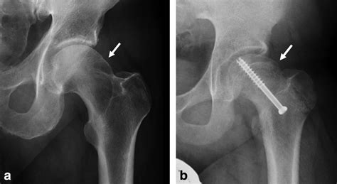 Mri Of The Hip For The Evaluation Of Femoroacetabular Impingement Past