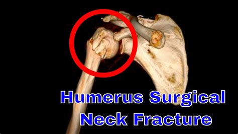 Humerus Neck Fracture