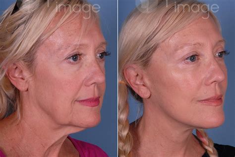 Mini Facelift Before And After