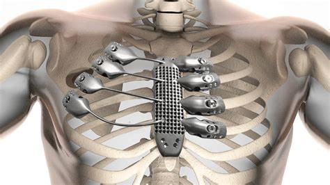 The Worlds First 3d Printed Titanium Rib Cage Is A Medical Marvel