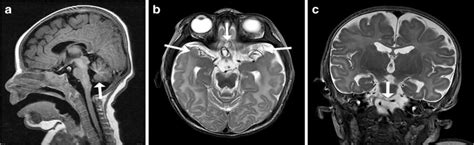 Menkes Disease X Rays