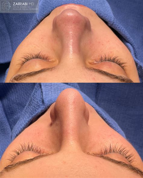 Closed Ultrasonic Piezo Rhinoplasty Dr Shahrouz Zarrabi Md