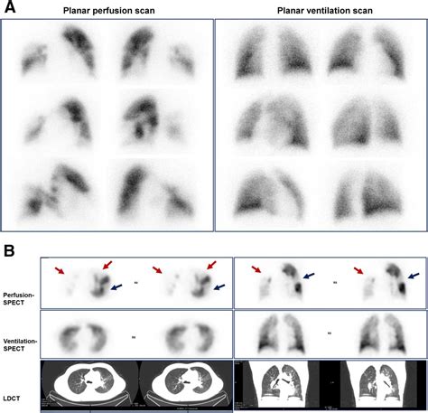 Lung Segments Vq