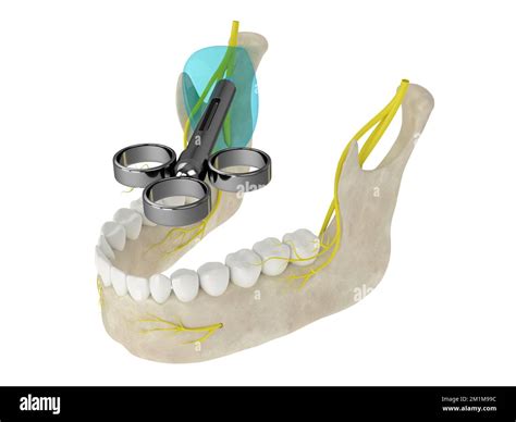 D Render Of Mandibular Arch With Gow Gates Nerve Block Types Of