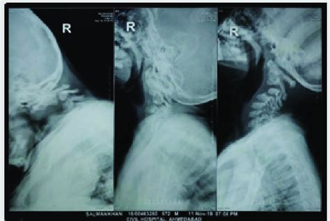 Pre Operative Radiographs In Anteroposterior Lateral Projections Of Download Scientific