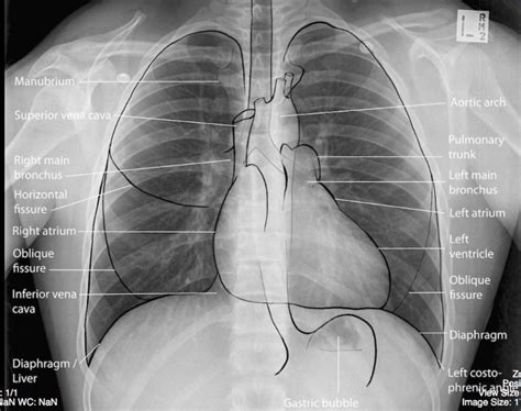 Normal Labelled Chest X Ray Undergraduate Diagnostic Imaging