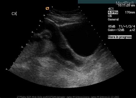 Dilated Cervix Ultrasound