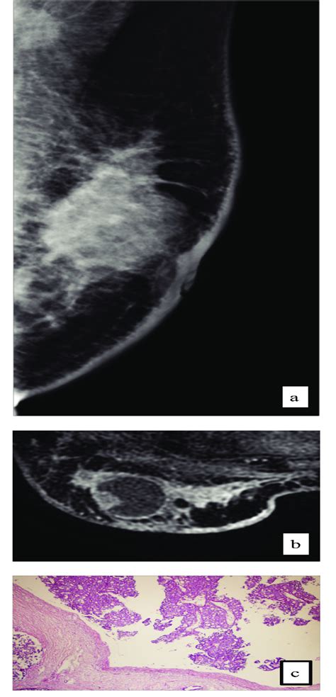 Encapsulated Papillary Carcinoma In A 50 Year Old Woman Who Presented Download Scientific