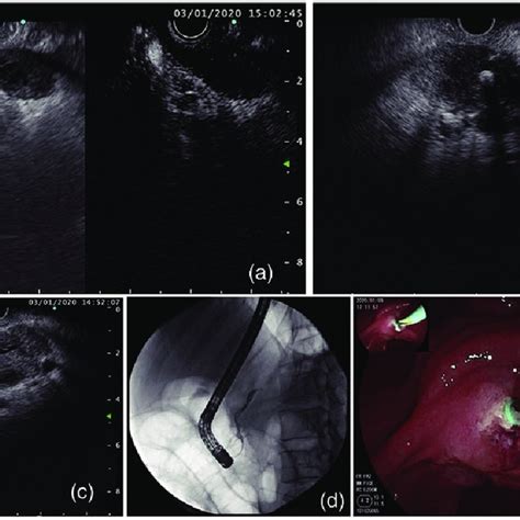 Computed Tomography And Endoscopic Ultrasound Eus Findings At The Download Scientific Diagram