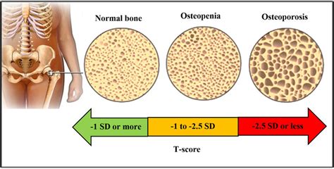 Comparative View Of Normal Bone Osteopenia And Osteoporosis 26