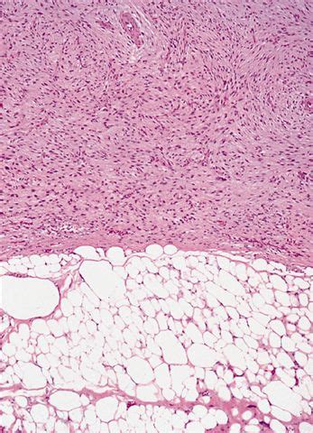 Pathology Outlines Dedifferentiated Liposarcoma