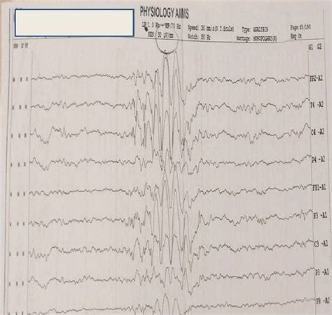 Eeg Of The Index Case With Typical Polyspike Andwaves Pattern