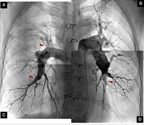 Figure From Balloon Pulmonary Angioplasty For Recurrent Lesions Six