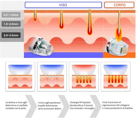 Radiofrequenza Frazionata Micro Needling RF BeautyMedlux Italia