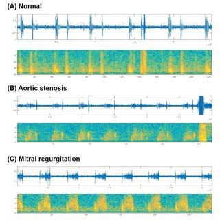 Representative phonocardiograms and spectrograms. (A) Normal heart... | Download Scientific Diagram