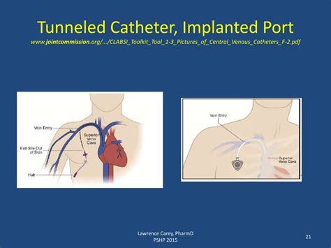 Non Tunneled Central Venous Catheter