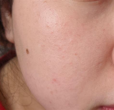 [skin Concerns] Damaged Moisture Barrier Closed Comedones Fungal Acne Please Help R