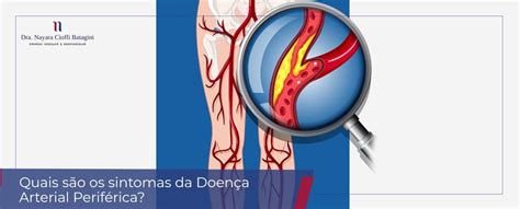 Quais são os sintomas da Doença Arterial Periférica