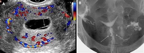 2two Different Patients With Endometrial Adhesions A Transverse Color