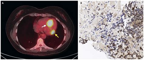 A Rare Case Of A Tumor Metastasizing To The Heart R Sciences