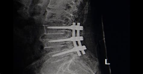 Lumbar Interbody Fusion Lake Charles La Spine And Brain Surgery