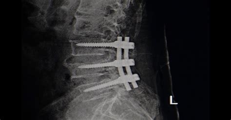 Lumbar Interbody Fusion Seattle Wa Brain And Spine Surgery