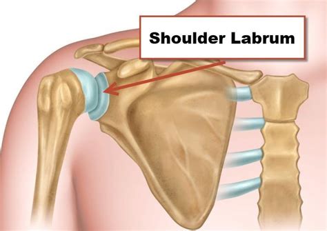 Superior Labral Tear