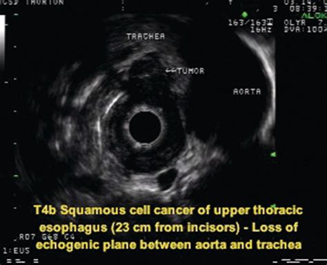 Esophagus Cancer Endoscopy