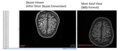 Dicom Output Orientation Support 3d Slicer Community