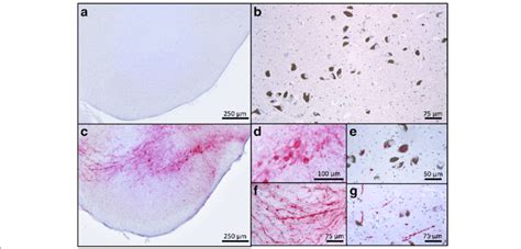 Aav12 A53t Asyn Sn Develop Insoluble Asyn Aggregates With Lewy Like