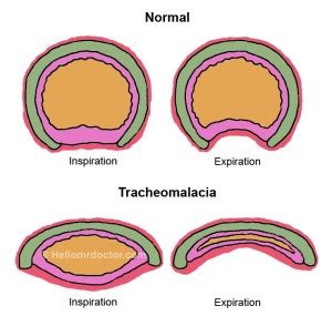 Tracheomalacia - Symptoms, Causes, Diagnosis, Treatment