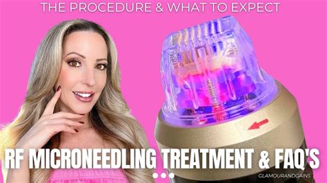 Radiofrequency Microneedling Treatment Faqs And Procedure Youtube