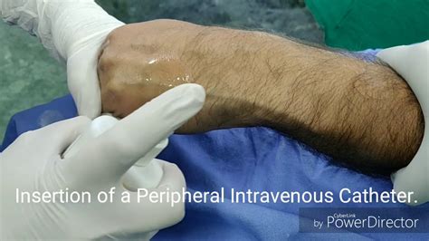 Insertion Of A Peripheral Intravenous Catheter Youtube